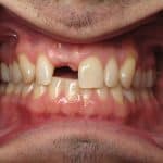 Burbank dental implant dentist