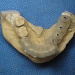 Burbank Los Angeles Dental implants Ramsey Amin (4)