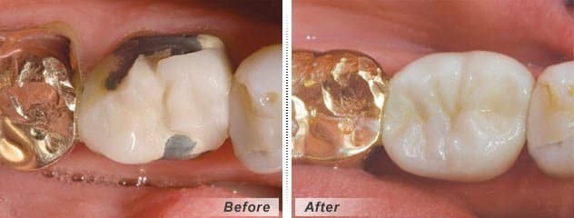 Photo Source: Ramsey Amin DDS| Published July 23, 2012 Solid Zirconium Crown and Implant Abutment