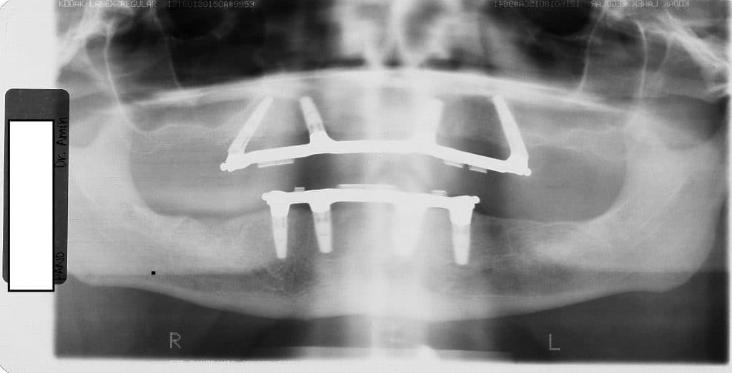 all on four xray ramsey amin dds (1)