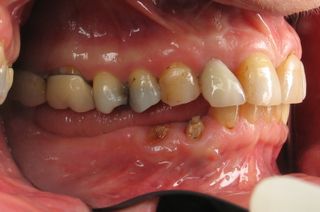 very little sapce between top and bottom teeth very little sapce between top and bottom teeth