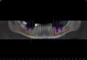 CT scan by Dr. Ramsey Amin, DDS CT scan by Dr. Ramsey Amin, DDS