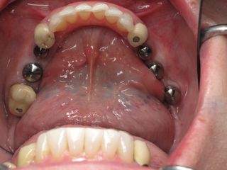 Lower Back teeth with implants healing Lower Back teeth with implants healing