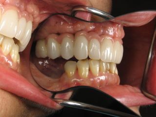 space between top and bottom teeth space between top and bottom teeth