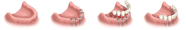 full mouth dental implants by Dr. Ramsey Amin, DDS full mouth dental implants by Dr. Ramsey Amin, DDS