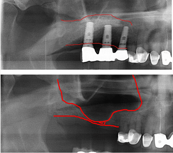 Sinus Lift Bone Graft Ramsey A. Amin, DDS