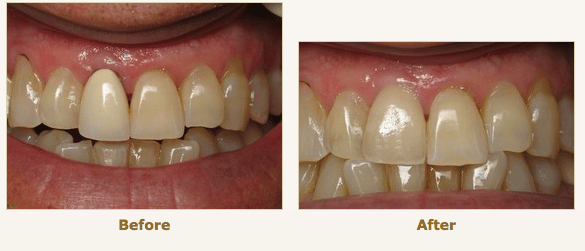 Porcelain Dental Crown Replacement Burbank, CA. Ramsey A