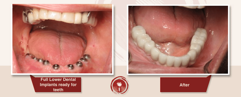 dental implants research paper dental implants research paper