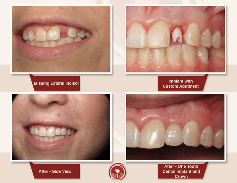 Cosmetic and Restorative Smile Gallery Porcelain Crowns Ramsey A. Amin, DDS