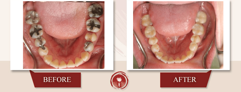 Porcelain Crowns (Caps) Porcelain Crowns (Caps)