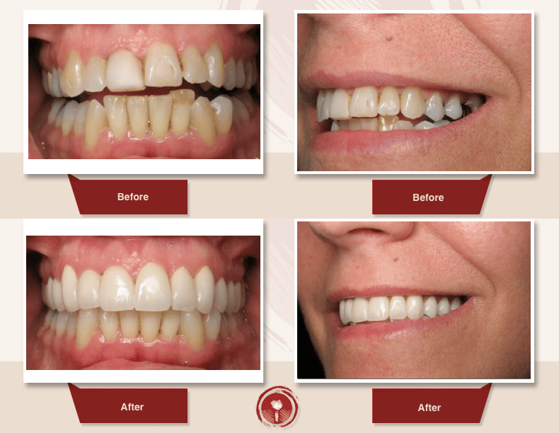 Cosmetic and Restorative Smile Gallery Porcelain Crowns Ramsey A. Amin, DDS