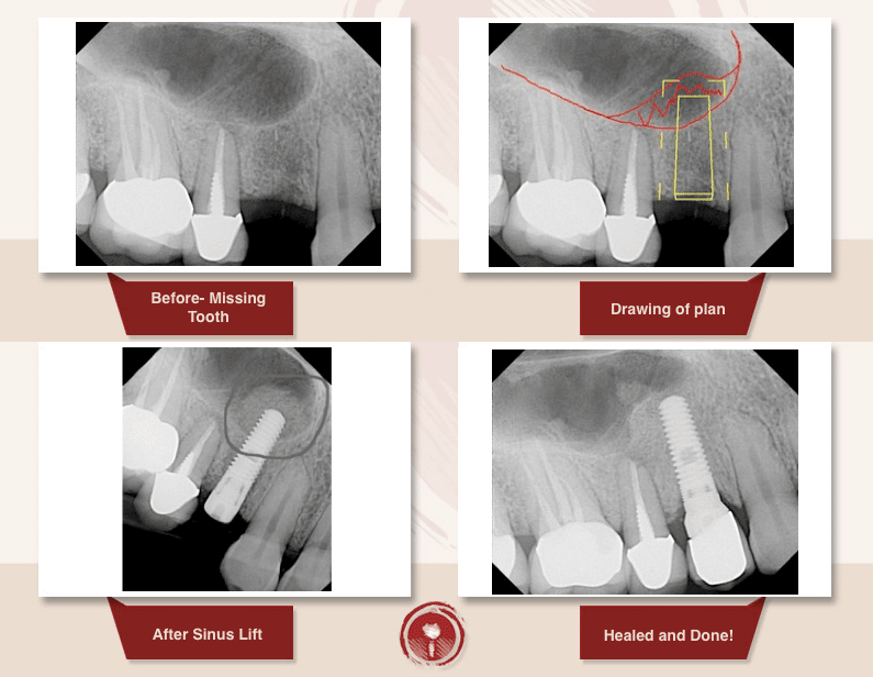 Bone Grafting Smile Gallery Sinus Lift Bone Graft Ramsey A. Amin, DDS