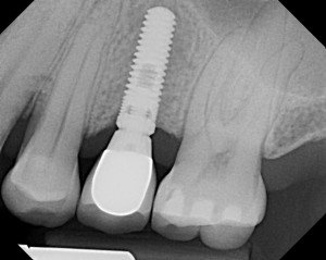 Burbank Dental Implants
