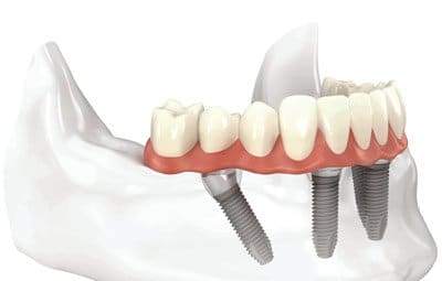 All On Four Dental Implant Procedure Review: Is It The ...