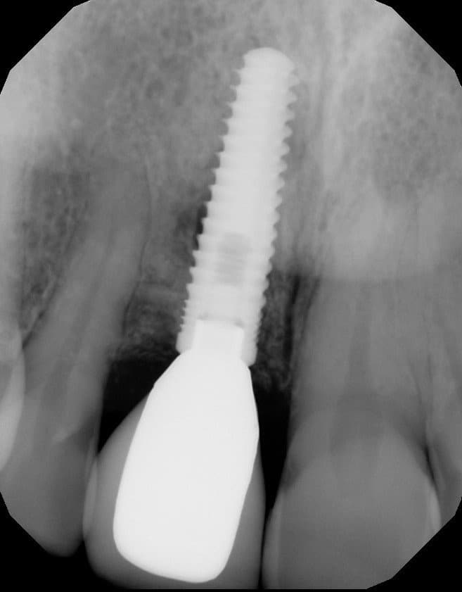 Dental Implant is Too Deep, Tooth Looks Long Ramsey A. Amin, DDS