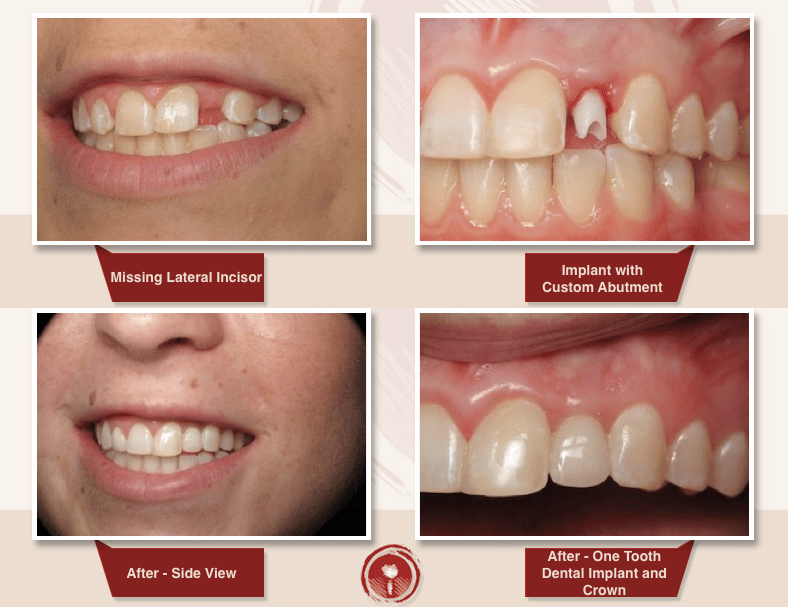 Dental Implants Los Angeles Area Implants Dentist Ramsey A. Amin, DDS