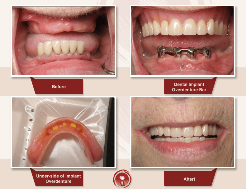 Dental Implants Los Angeles Area Implants Dentist Ramsey A. Amin, DDS