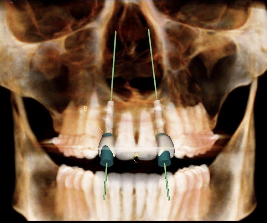 Block Bone Graft for Dental Implants 2015 UpdateRamsey Amin DDS