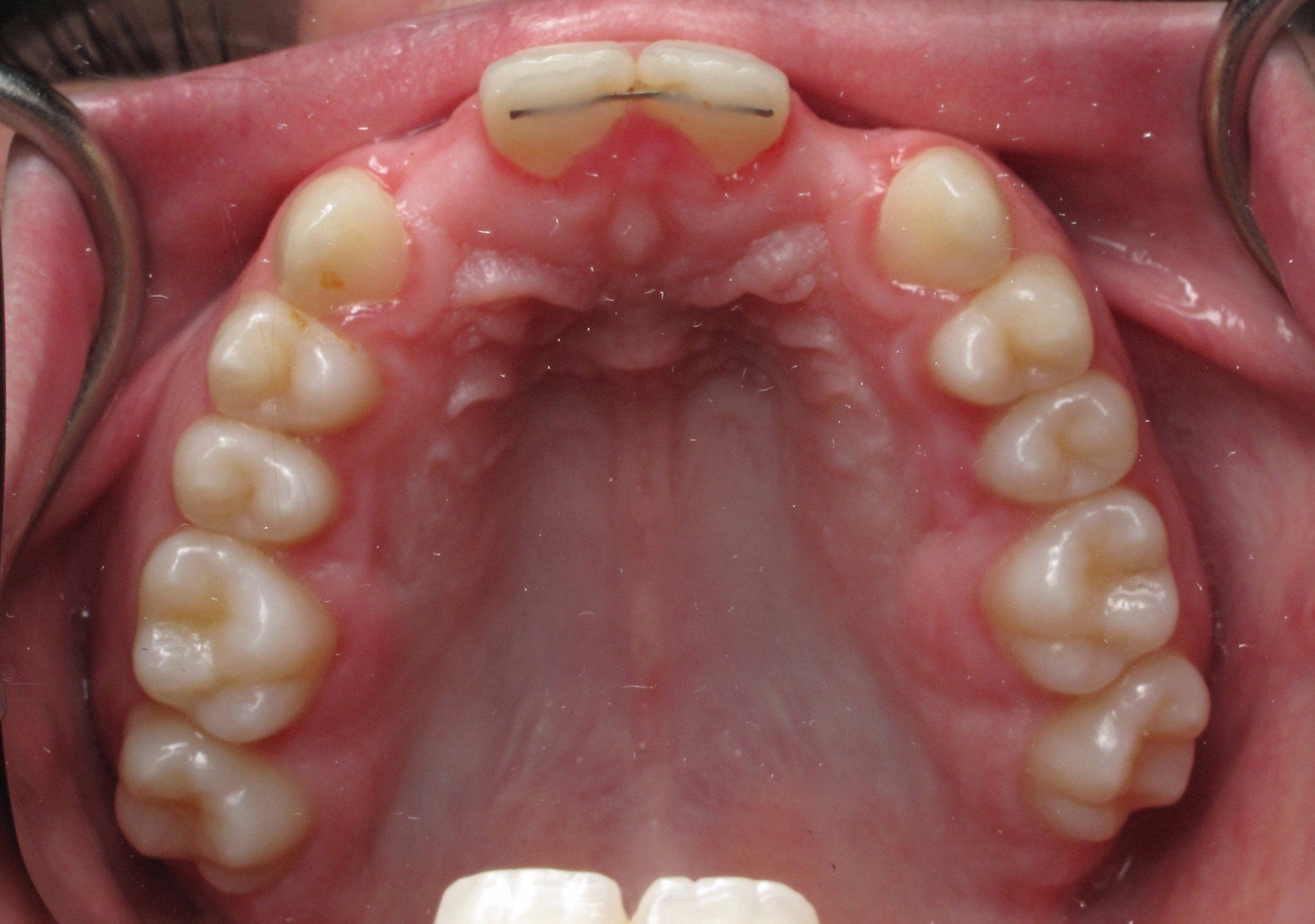 Block Bone Graft for Dental Implants 2015 UpdateRamsey Amin DDS