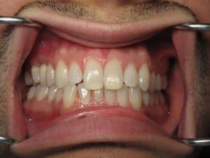 Forum on this topic: Pros and Cons of Wisdom Teeth Extraction, pros-and-cons-of-wisdom-teeth-extraction/ Forum on this topic: Pros and Cons of Wisdom Teeth Extraction, pros-and-cons-of-wisdom-teeth-extraction/