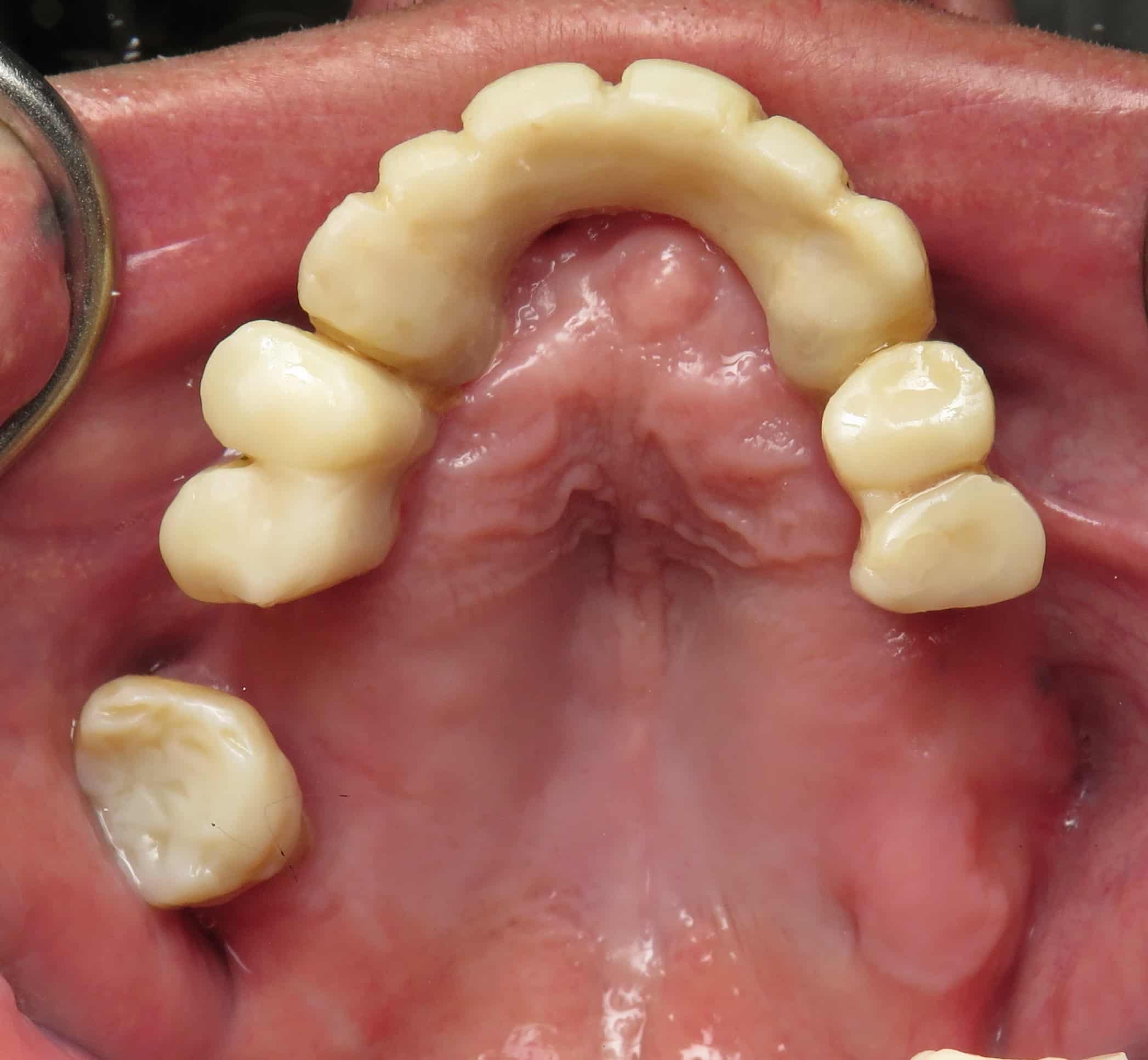 All On Dental Implants With Prettau Solid Zirconia Dental Implant