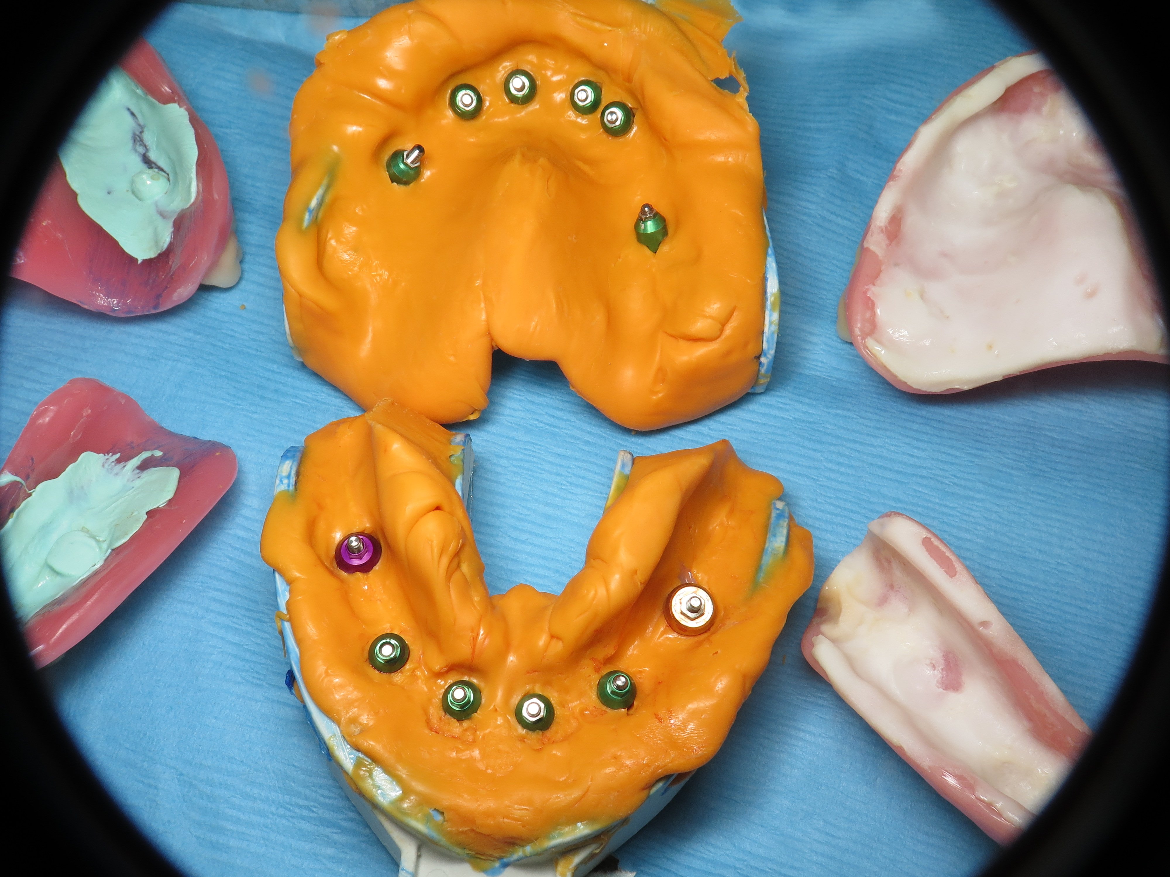 All On Dental Implants With Prettau Solid Zirconia Dental Implant