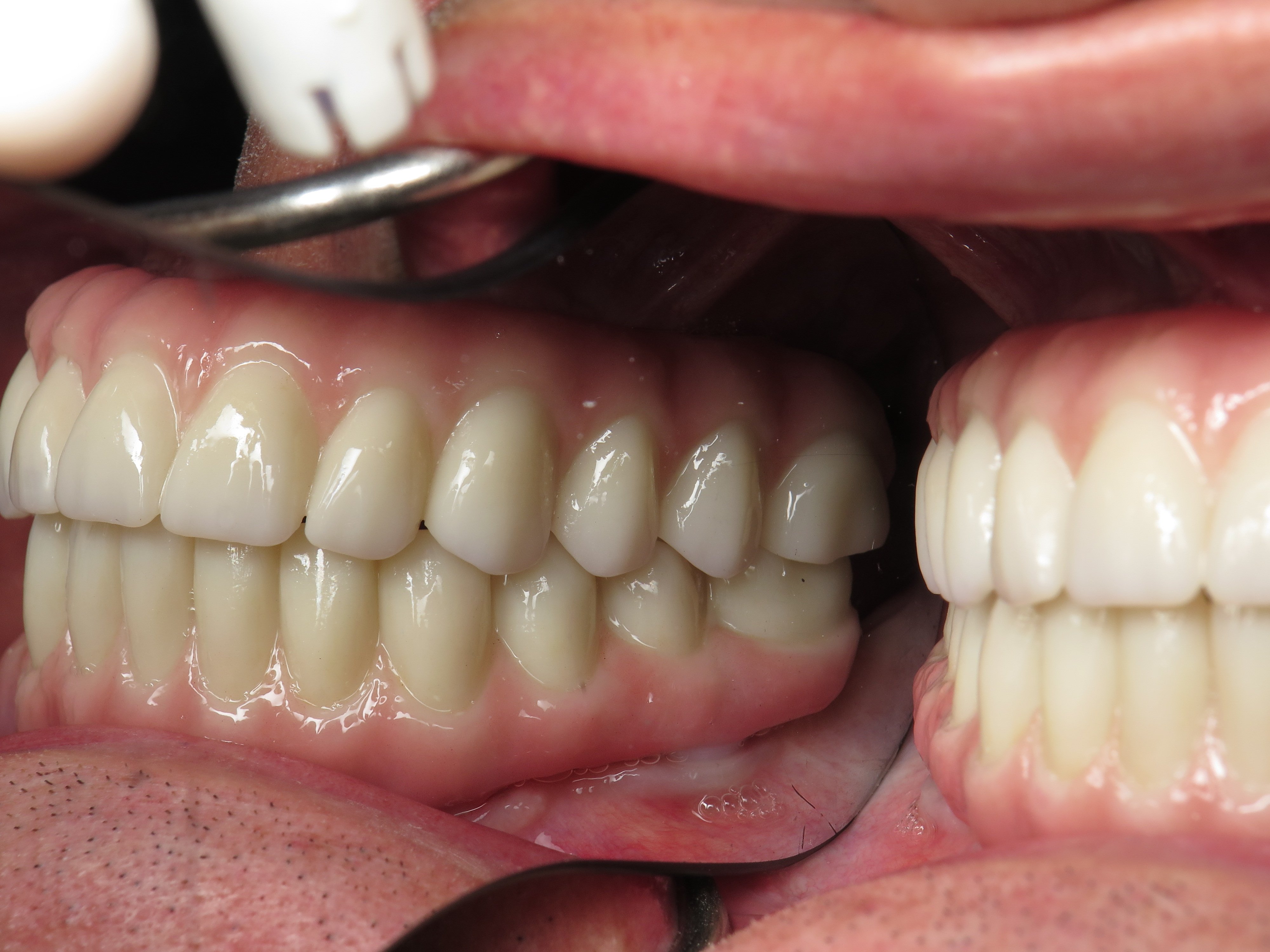 All On Dental Implants With Prettau Solid Zirconia Dental Implant Bridges A Case Explained