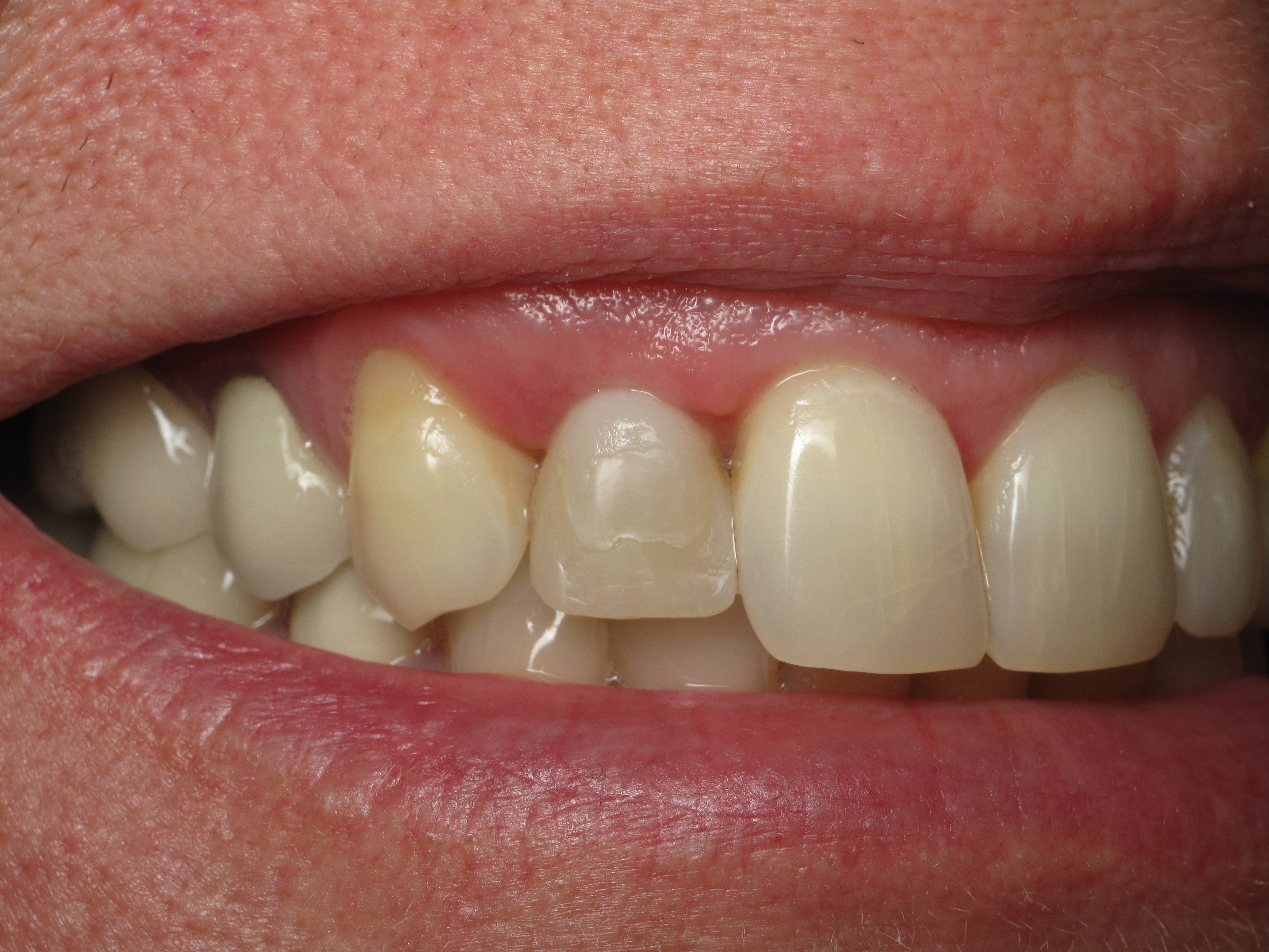 Shaping And Forming Gum Around Front Teeth Dental Implants Ramsey