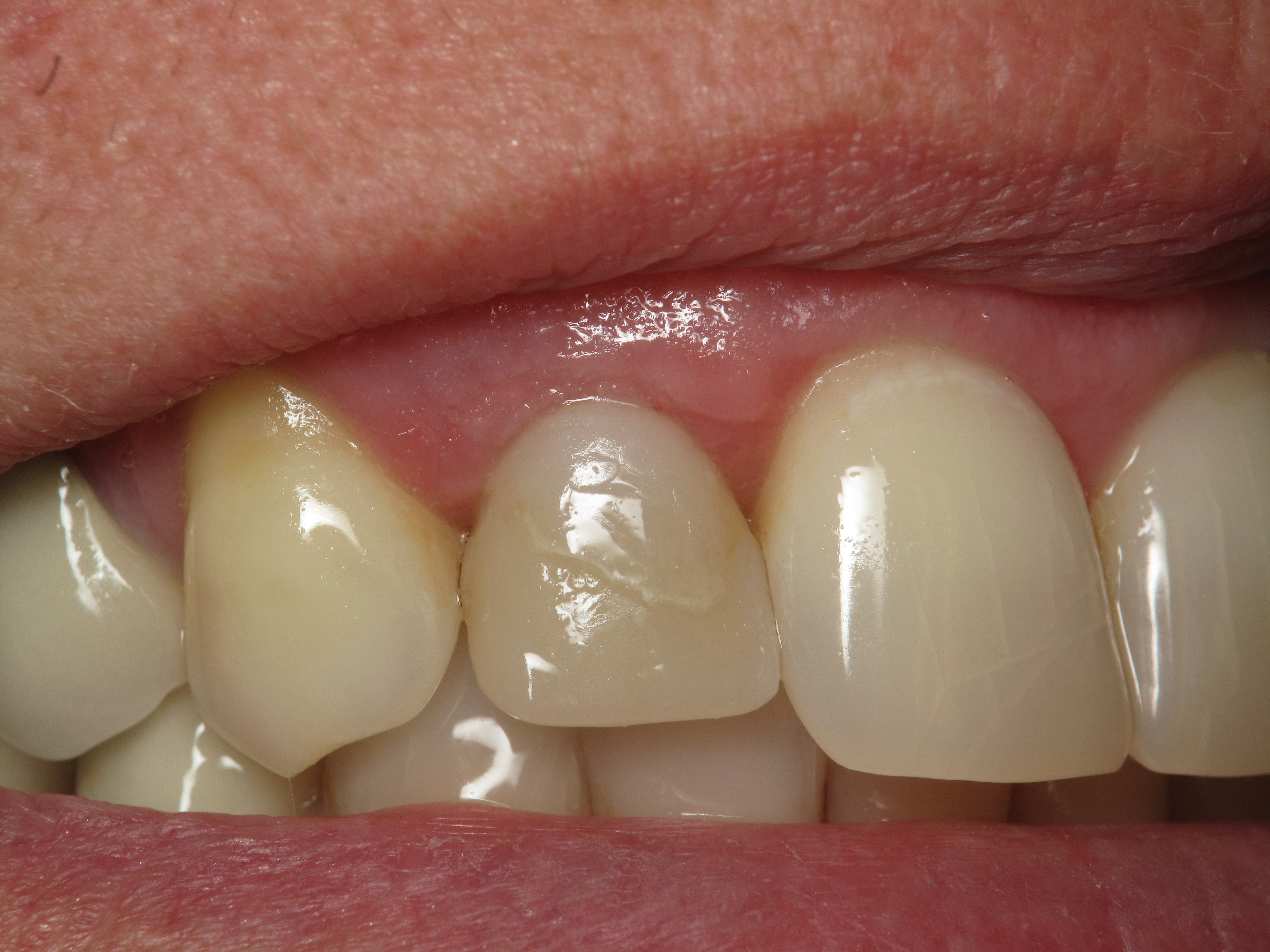 Shaping And Forming Gum Around Front Teeth Dental Implants Ramsey