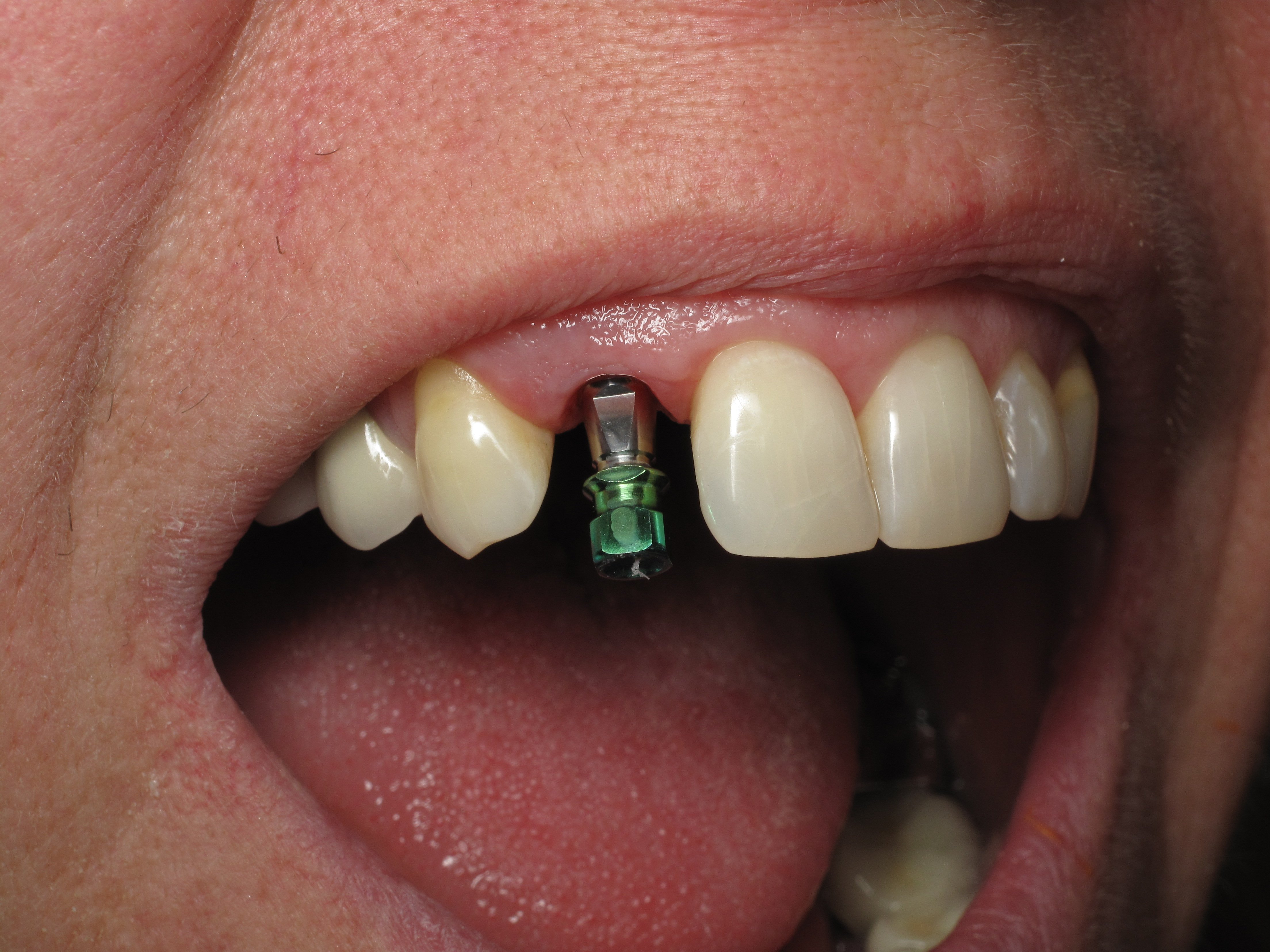 Shaping And Forming Gum Around Front Teeth Dental Implants Ramsey Amin DDS Reviews Ramsey A