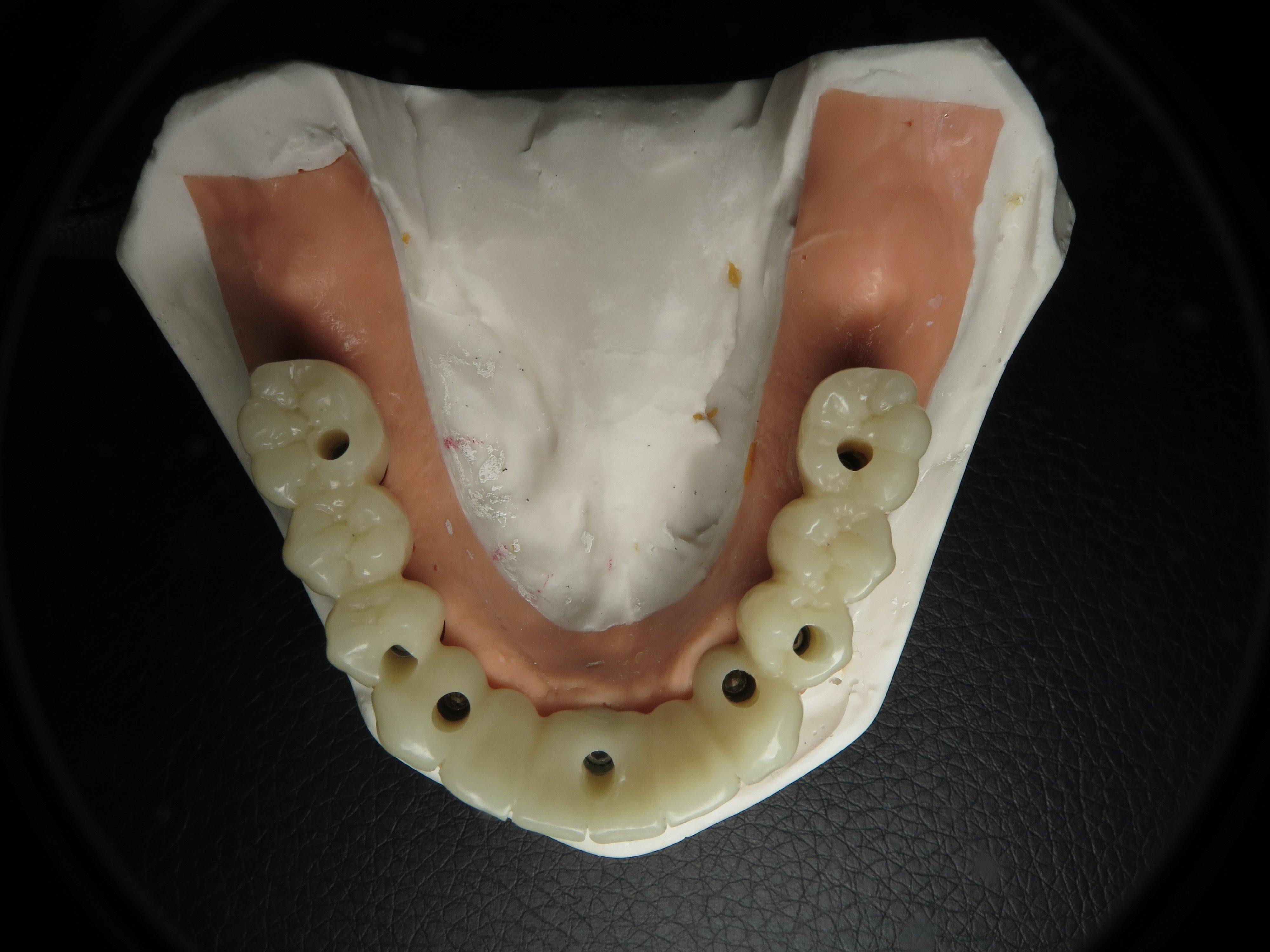 Converting Bad Dental Implant Overdentures To Fixed Full Arch Bridges