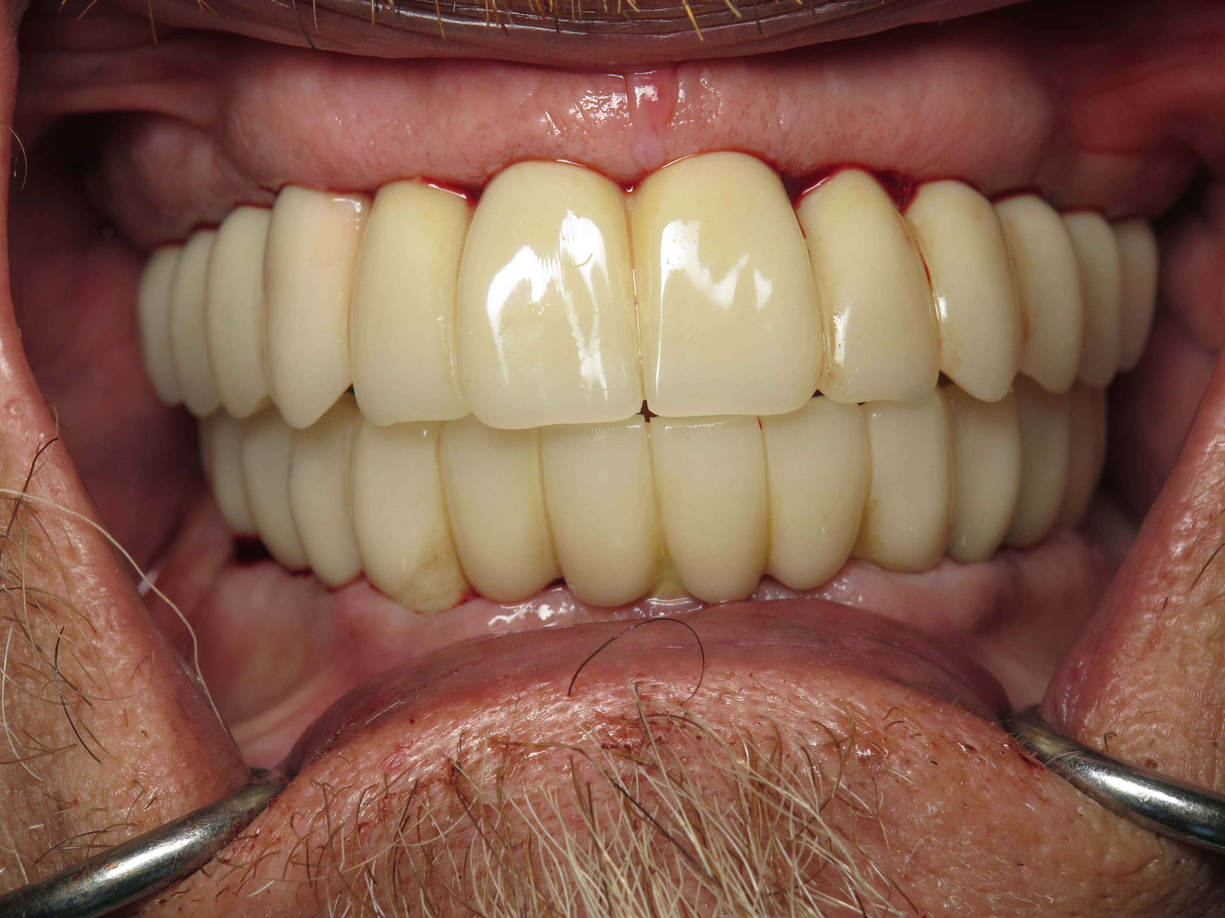 Converting Bad Dental Implant Overdentures To Fixed Full Arch Bridges