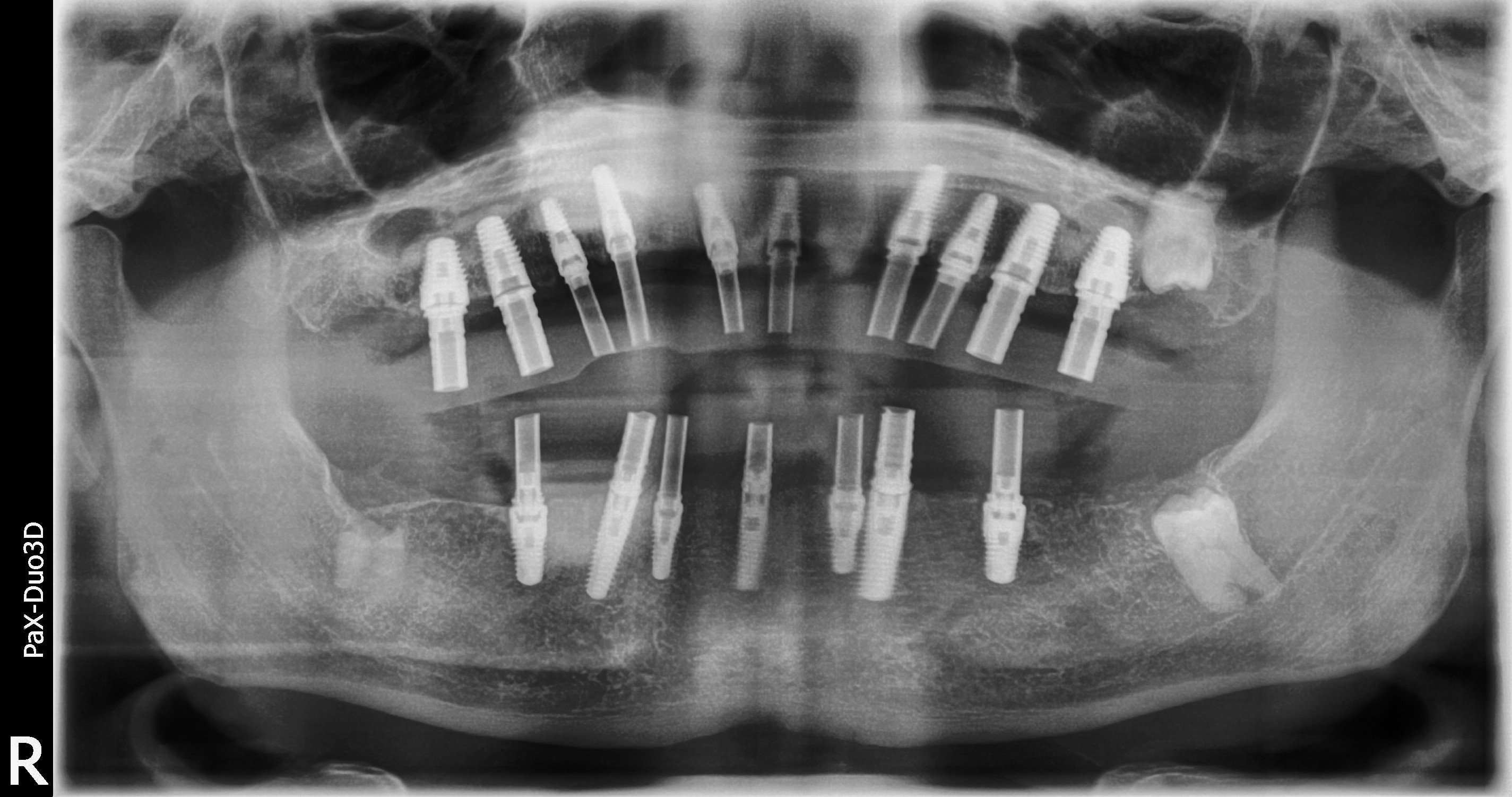 Converting Bad Dental Implant Overdentures To Fixed Full Arch Bridges