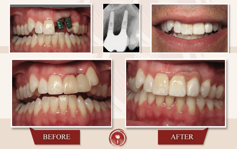 Dental Implants Los Angeles Area Implants Dentist Ramsey A. Amin, DDS
