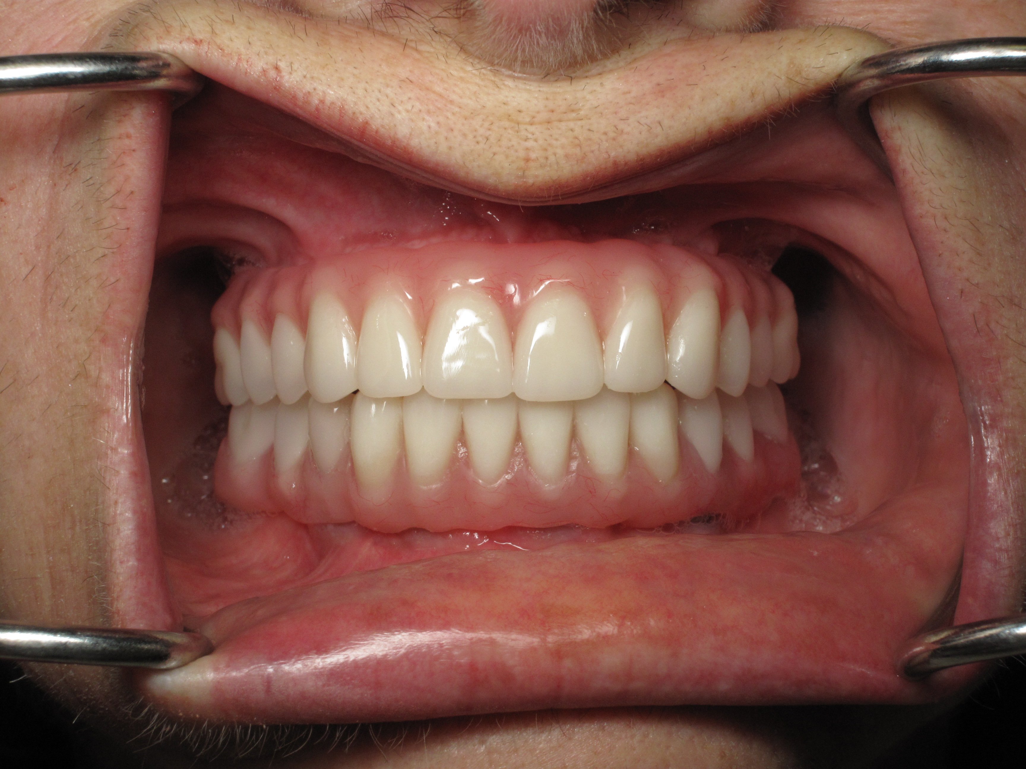 Temporary Full Implant Teeth Why Do This Step Ramsey A Amin DDS