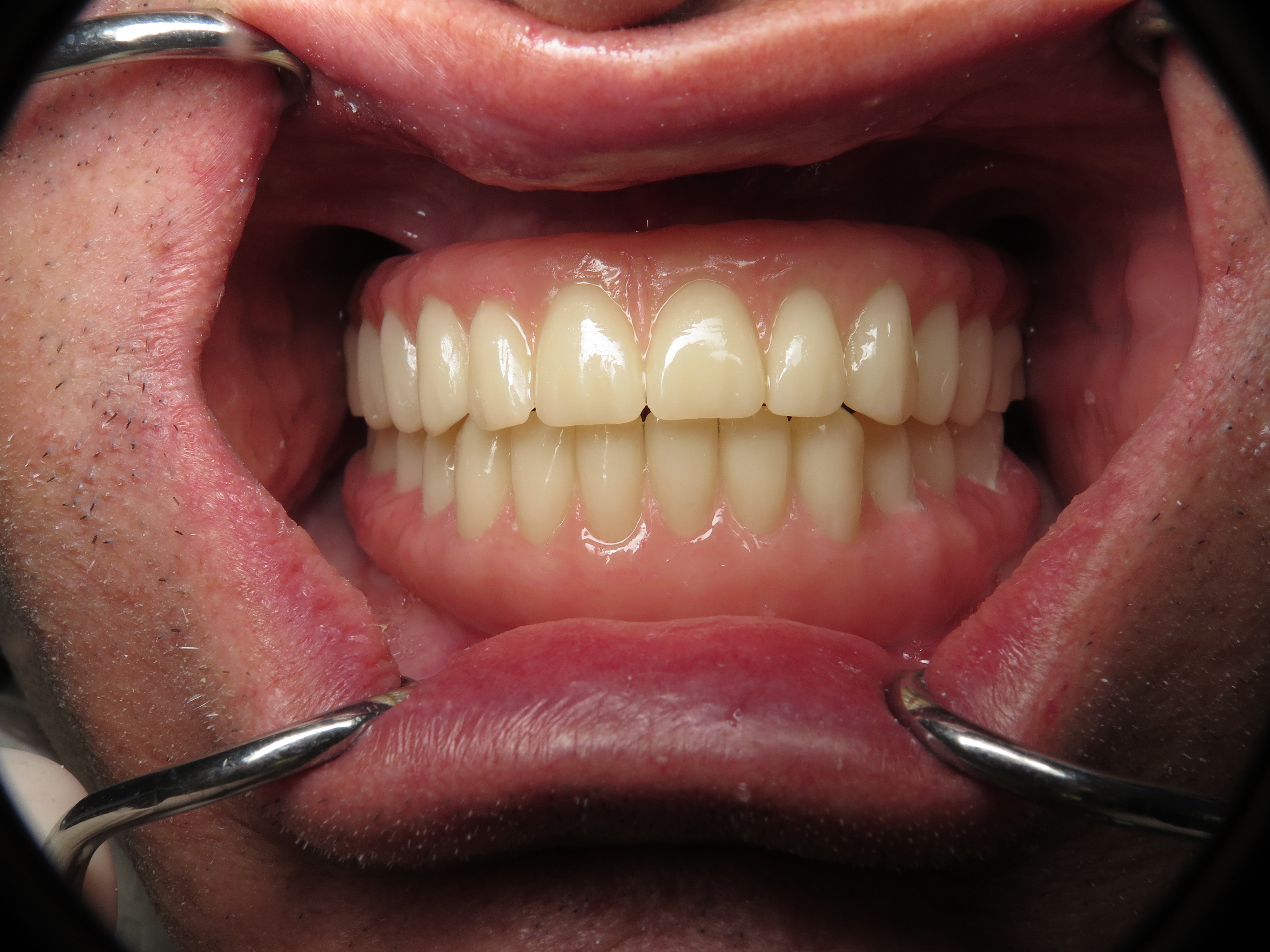 Temporary Full Implant Teeth Why Do This Step Ramsey A Amin DDS