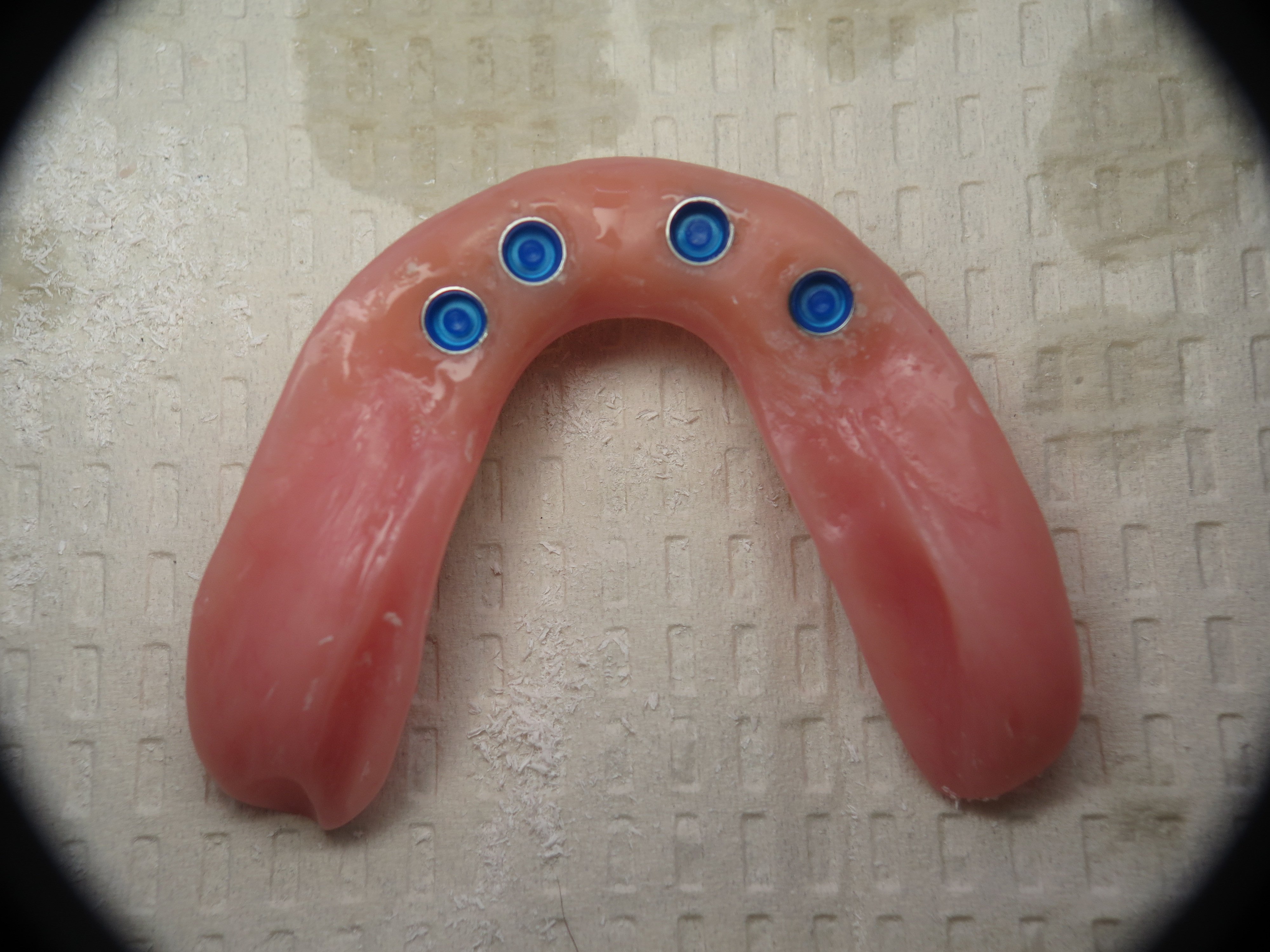 ComplicationsBone Graft For Failed Full Lower Dental Implants Ramsey