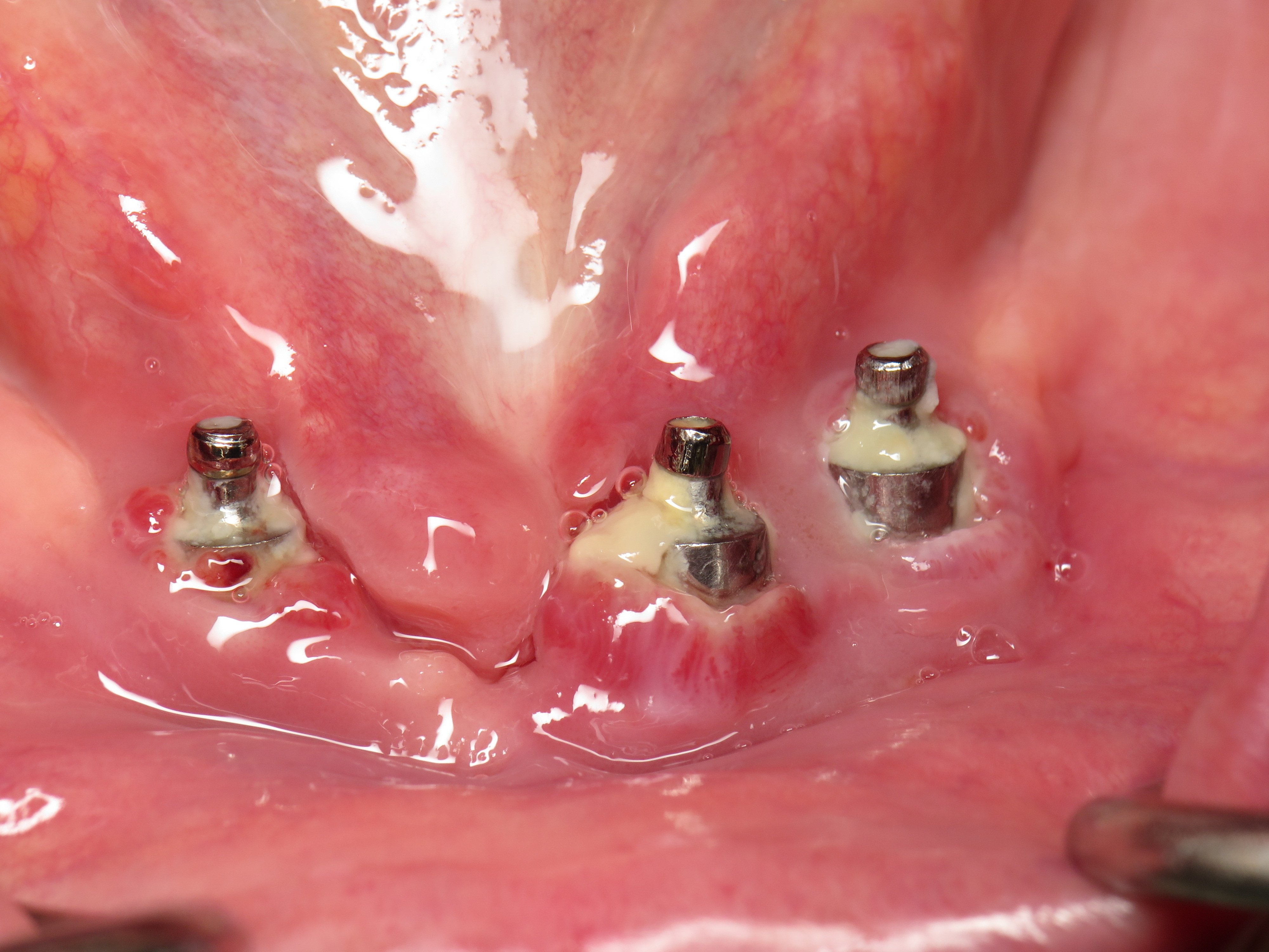 ComplicationsBone Graft For Failed Full Lower Dental Implants Ramsey