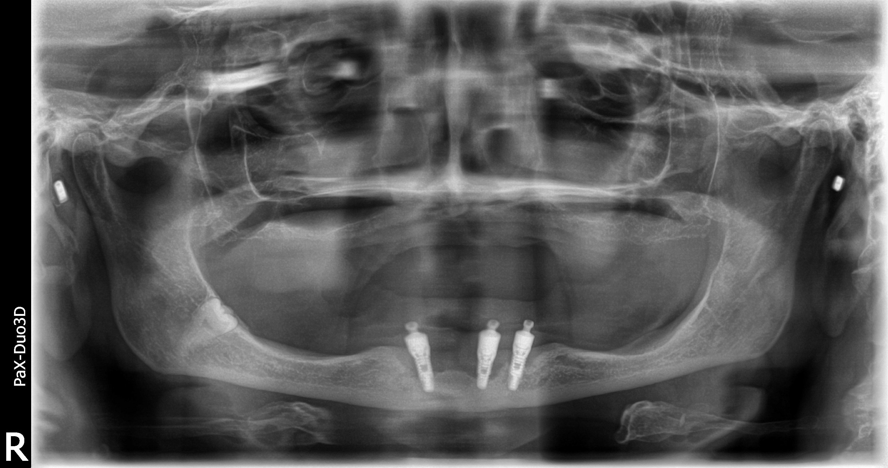 ComplicationsBone Graft For Failed Full Lower Dental Implants Ramsey