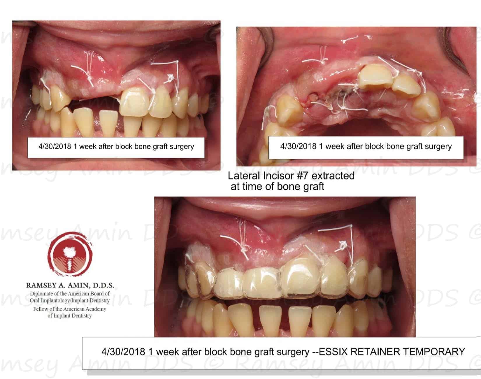 Complication Bone Graft is Exposed Platelet PRF Treatment Ramsey A. Amin, DDS