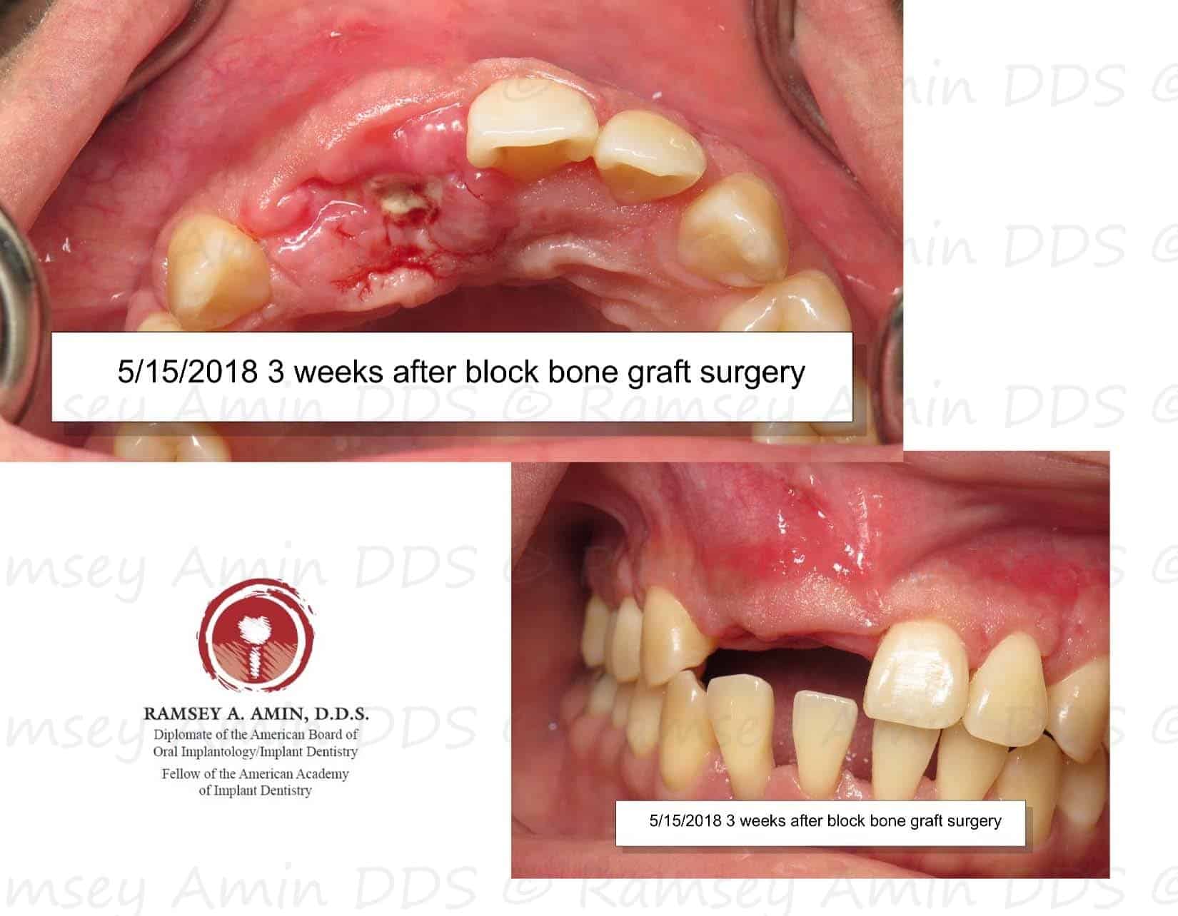 Complication Bone Graft is Exposed Platelet PRF Treatment Ramsey A. Amin, DDS