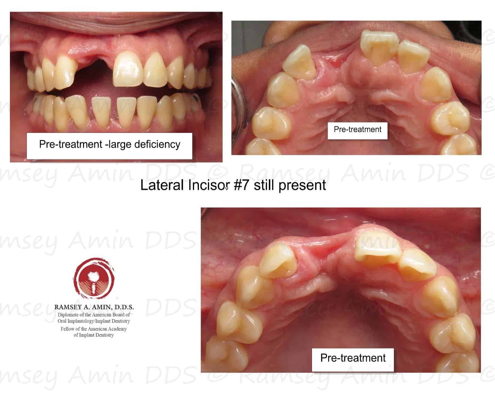 Complication Bone Graft is Exposed Platelet PRF Treatment Ramsey