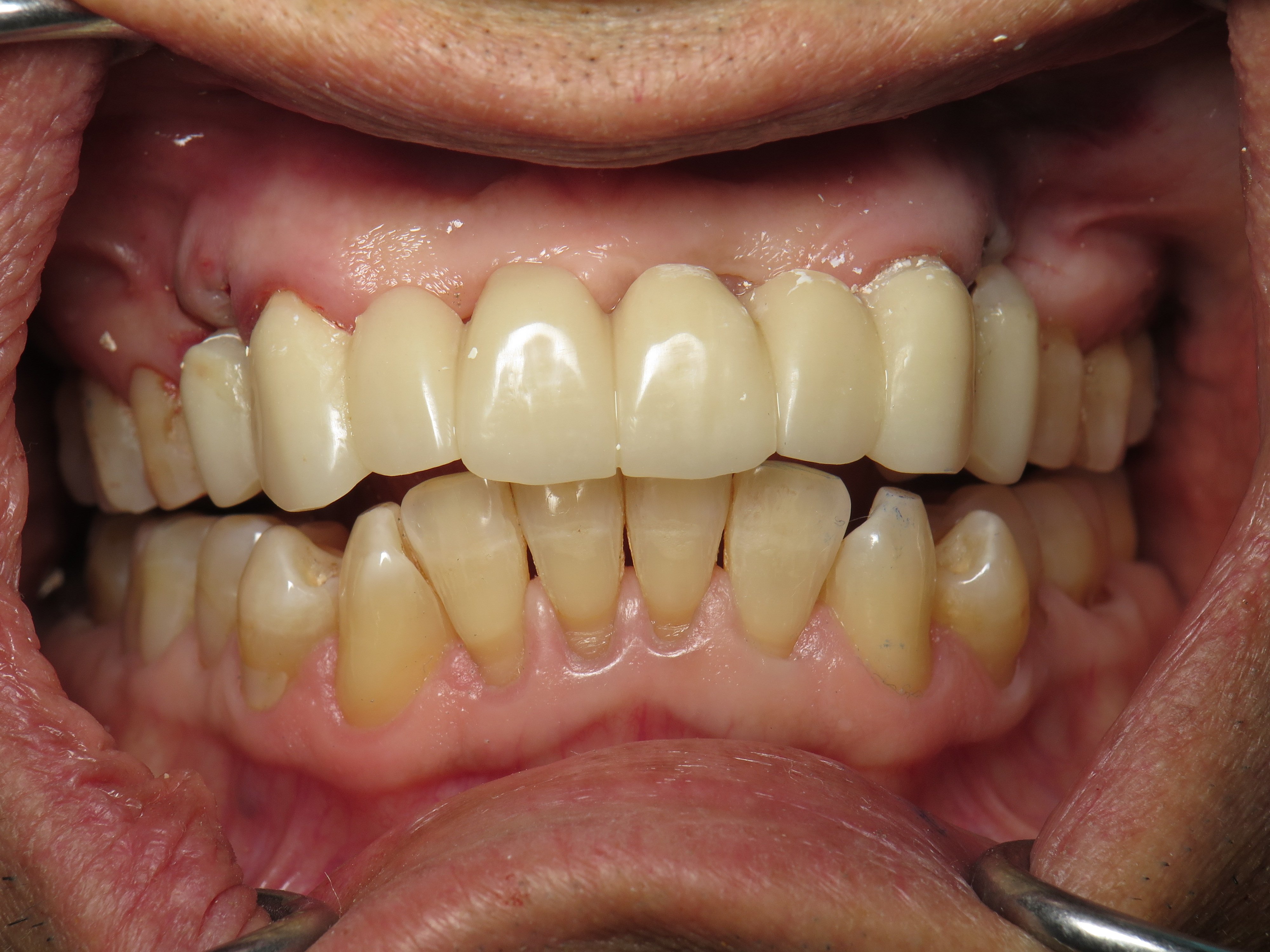 Flipper Stayplate Bridge Temporary Implant Bone Graft Facts Ramsey A