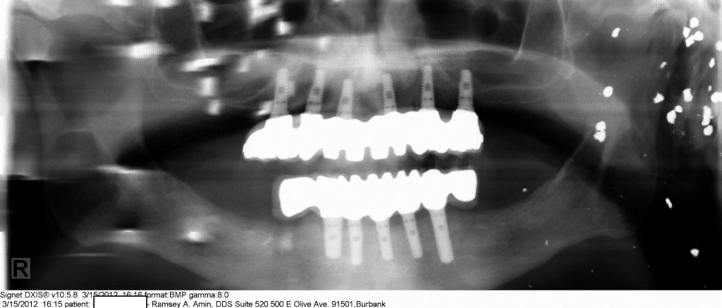 Burbank Dental implant specialist Los Angeles Burbank Dental implant specialist Los Angeles
