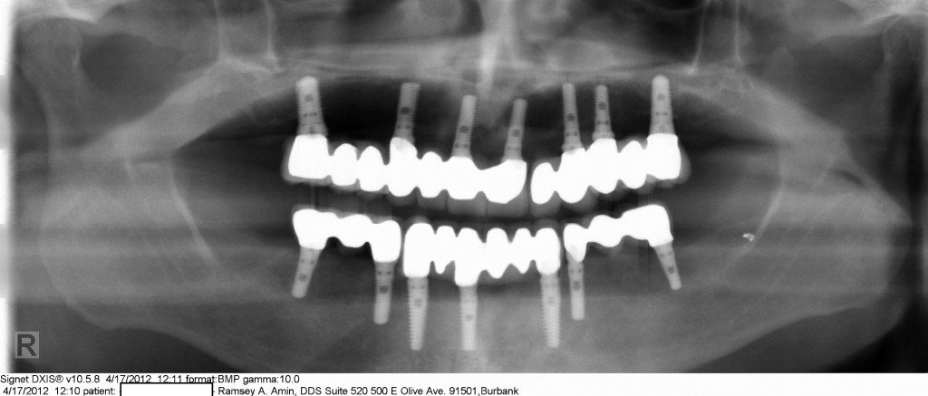 Burbank Dental implant specialist Los Angeles (2) Burbank Dental implant specialist Los Angeles (2)