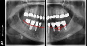 dental implant bone loss