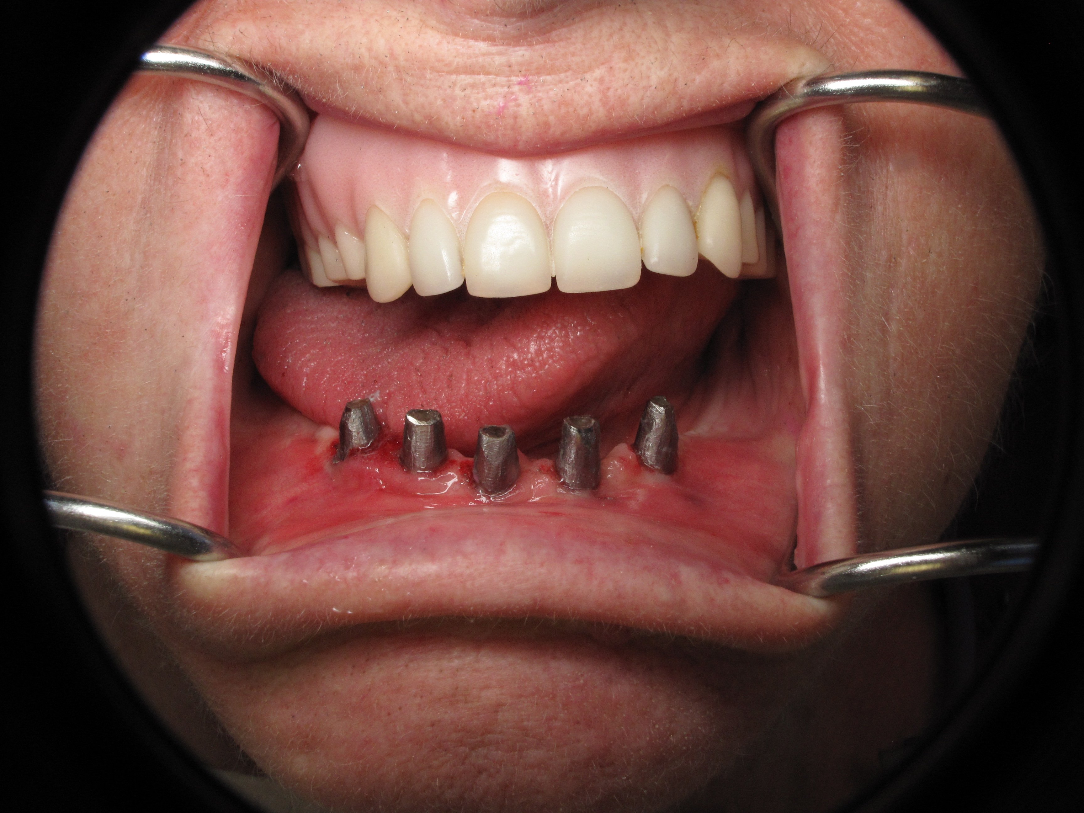 is talk pulling like him to teeth Getting is talk pulling like him to teeth Getting