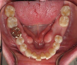 Bone Graft Done