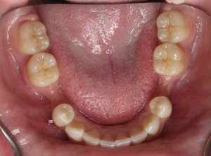 Bone Graft NOT done