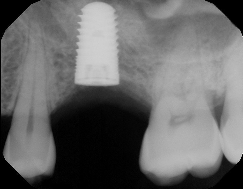 Internal sinus lift dental implant x-ray